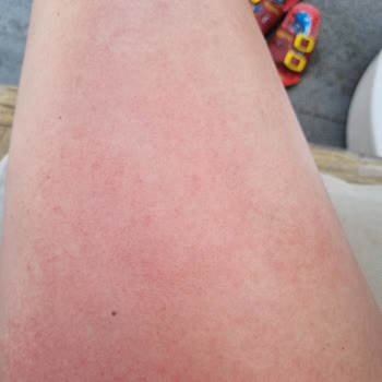 Mustela Güneş Kremi Alerji Yaptı, Tatilim Mahvoldu!