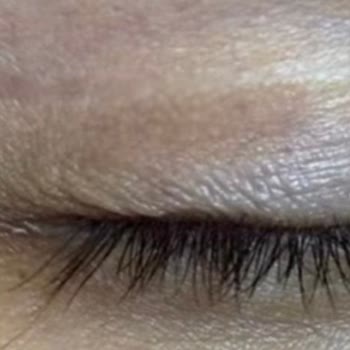 Göz Kapağı Ameliyatı Sonrası Geçmeyen İzler Ve Kötü Muamele