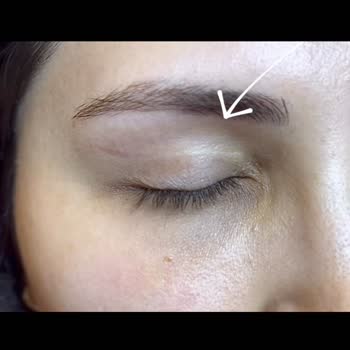 Göz Kapağı Ameliyatı Sonrası Geçmeyen İzler Ve Kötü Muamele