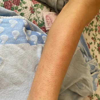 Epify Tüy Dökücü Krem Ciltte Şiddetli Yanma Ve Kızarıklık Yaptı