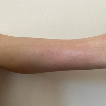 Epify Tüy Dökücü Krem Ciltte Şiddetli Yanma Ve Kızarıklık Yaptı