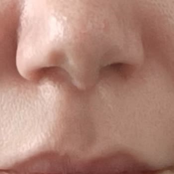 Burun Estetiği Sonrası Ciddi Fiziksel Ve Psikolojik Mağduriyet