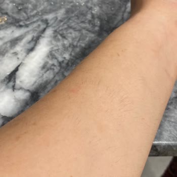 Duman Beauty Yanıltıcı Fiyatlandırma ve Sağlık Sorunlarıyla Sonuçlanan Acı Verici Lazer Deneyimi