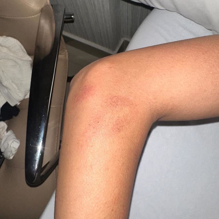 Müge Ekinci Sym Lazer Yaptırmam Sonucu Kolumu Yaktılar