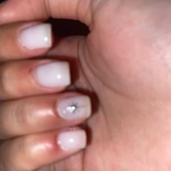 Manikür Sonrası Tırnak Etlerimde Sürekli Kanama Ve İltihap