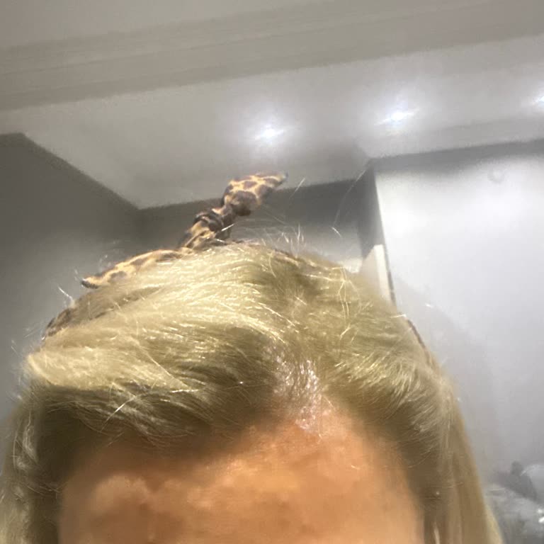 Dolgu Ve Botoks İşlemi Sonrası Yaşanan Sağlık Sorunları Ve Memnuniyetsizlik