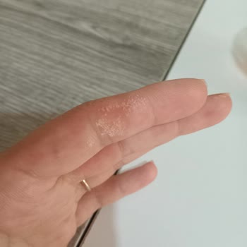 Kullandığım Ürün Elimi Yaktı, Acile Başvurdum