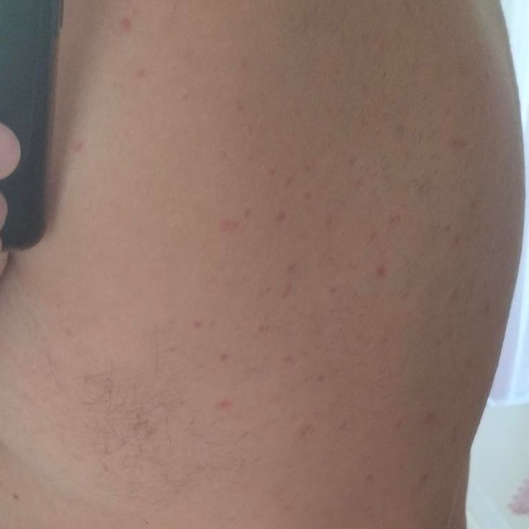 Veet Erkek Tüy Dökücü Krem Sonrası Ciddi Cilt Sorunları Ve Kalıcı Sivilceler