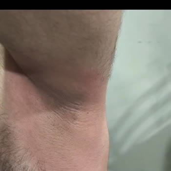 BİM'den Alınan Nivea Koltuk Altı Ürünü Cildimde Yanma Ve Acıya Sebep Oldu