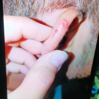 Lazer Epilasyon Sırasında Yaşanan Yanık Ve Eksik Hizmet