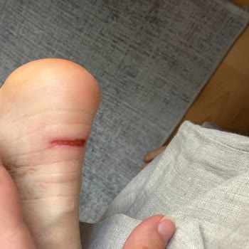 Ayakkabı Ayağımı Yaraladı, İade Sürecinde Mağduriyet Yaşadım