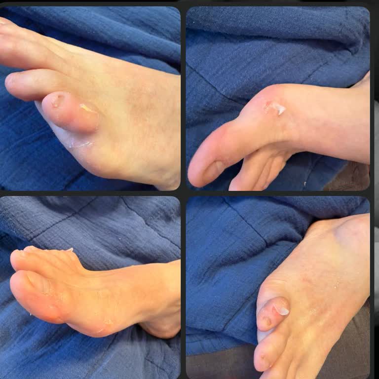 Gurur Tekstil Aldığım Sandalet Ayağımı Yaraladı, İade Sürecinde Mağdur Edildim