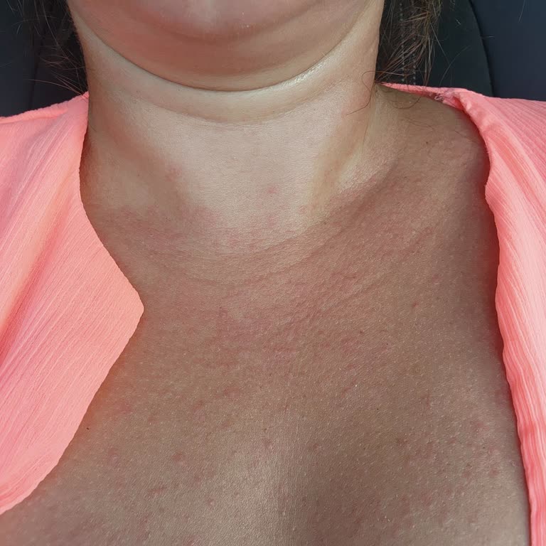 Cire Aseptine Aldığım Güneş Kremi Cildimde Tahrişe Ve Döküntüye Yol Açtı