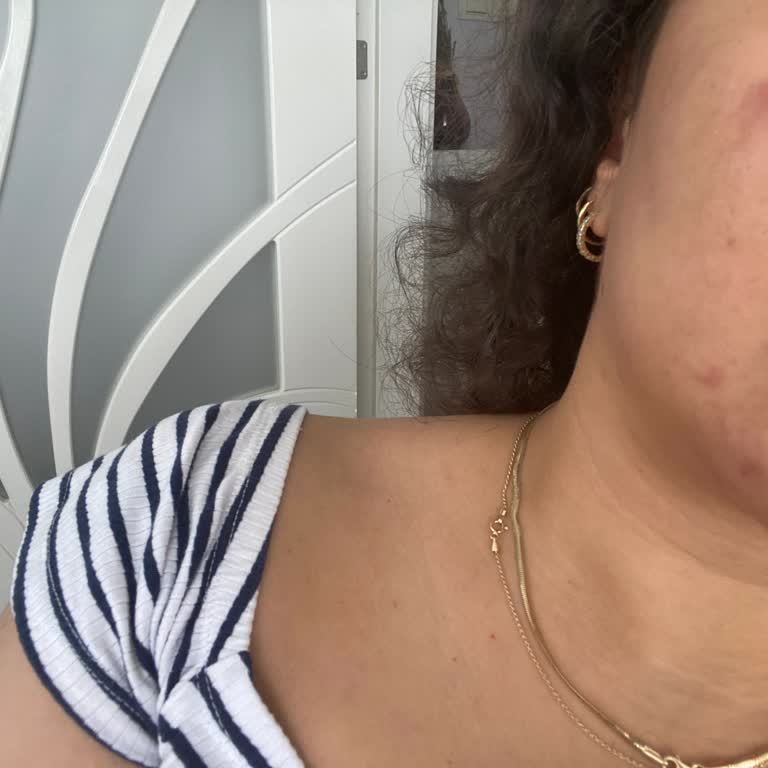 Yves Rocher Yağlanma Karşıtı Güneş Kremi Sonrası Yüzümde Yoğun Sivilce Oluştu