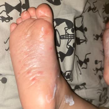 Çocuk Havuzundan Mikrop Kapıp El Ayak Hastalığına Yakalandık