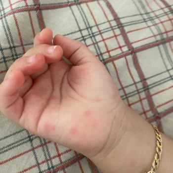 Çocuk Havuzundan Mikrop Kapıp El Ayak Hastalığına Yakalandık