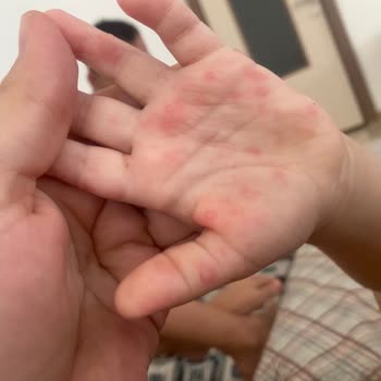 Çocuk Havuzundan Mikrop Kapıp El Ayak Hastalığına Yakalandık