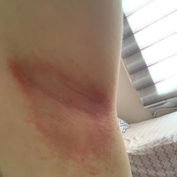 Doğal Roll-On Ciltte Alerjiye Sebep Oldu