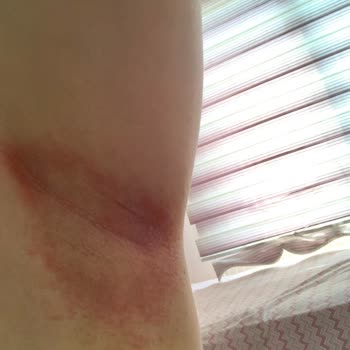 Doğal Roll-On Ciltte Alerjiye Sebep Oldu