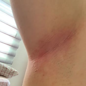 Doğal Roll-On Ciltte Alerjiye Sebep Oldu