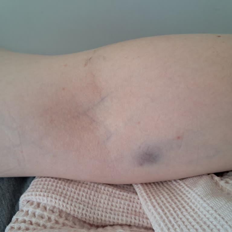 Acilde Hemşire Hatası Sonrası İlgisizlik Ve Annemin Yaşadığı Acı