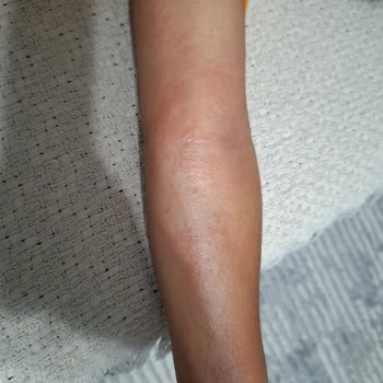 Nivea Sun Güneş Kremi Çocuğumda Cilt Sorununa Yol Açtı