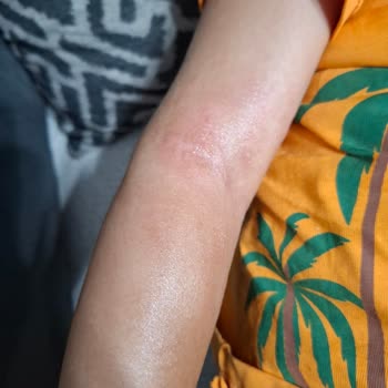 Nivea Sun Güneş Kremi Çocuğumda Cilt Sorununa Yol Açtı