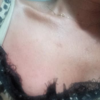 Güneş Koruyucu Kullanımı Sonrası Ciltte Şiddetli Reaksiyon