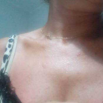 Güneş Koruyucu Kullanımı Sonrası Ciltte Şiddetli Reaksiyon