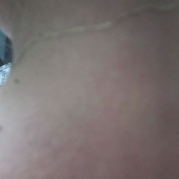 Güneş Koruyucu Kullanımı Sonrası Ciltte Şiddetli Reaksiyon