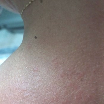 Güneş Koruyucu Kullanımı Sonrası Ciltte Şiddetli Reaksiyon