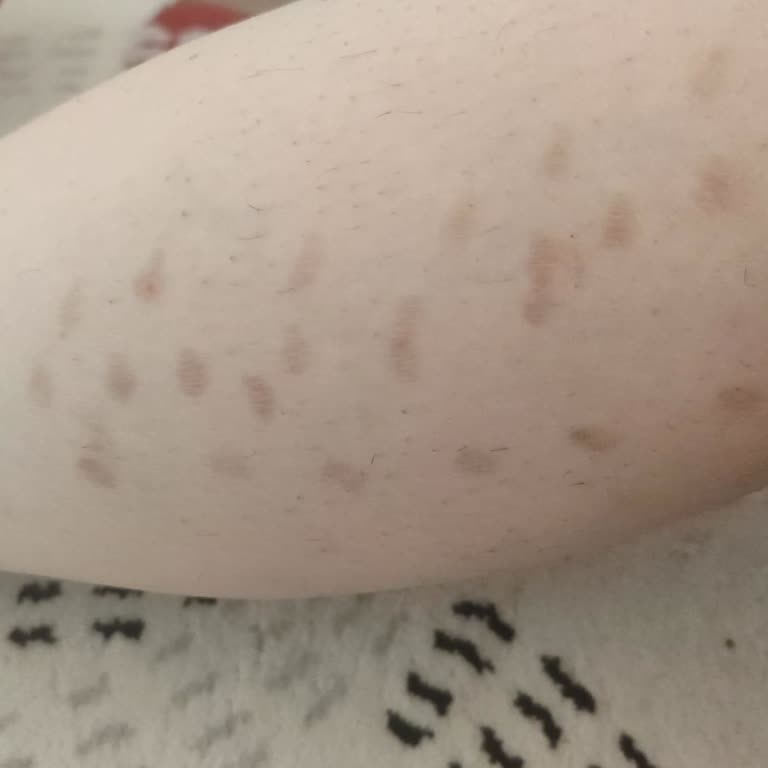 Sivas Suit Güzellik Merkezi'nde Lazer Uygulaması Sonrası Yanık Ve Olumsuz Davranışlar