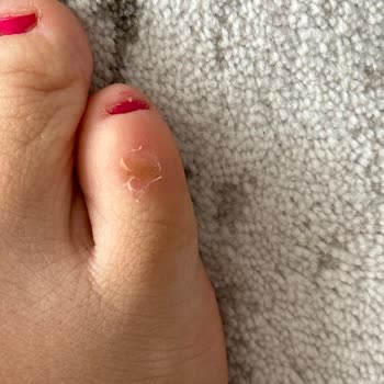 Aldığım Sandalet Ayağımı Yaraladı, Mağaza İlgisiz Davrandı