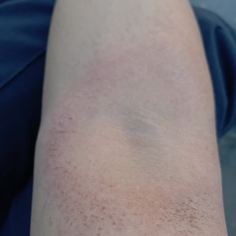 Tüy Dökücü Krem Cildimde Yanık Ve Tahrişe Sebep Oldu