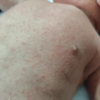 Mustela Bebek Şampuanı Alerji Yaptı Ve Vücudu Kabardı