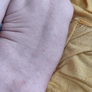 Mustela Bebek Şampuanı Alerji Yaptı Ve Vücudu Kabardı