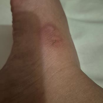 Aldığım Terlikler Ayağımı Yaraladı, Tatilim Mahvoldu