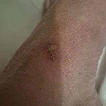 Aldığım Terlikler Ayağımı Yaraladı, Tatilim Mahvoldu