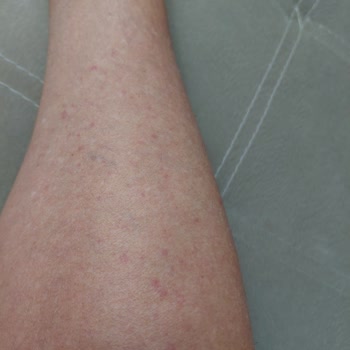 Eda Taşpınar Yağı Sonrası Alerji Ve Tatil Mağduriyeti