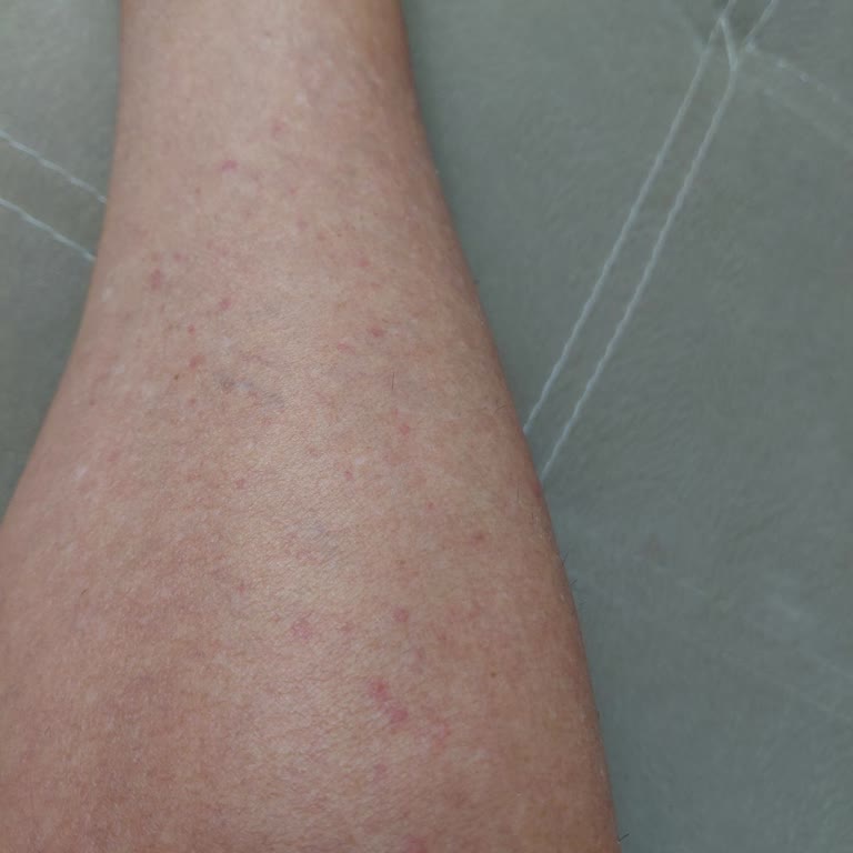 Eda Taşpınar Yağı Sonrası Alerji Ve Tatil Mağduriyeti