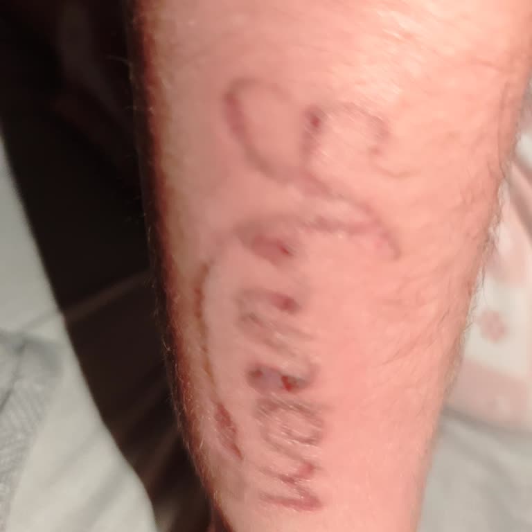 Dövme Sildirme Sürecinde Beklenmedik Ek Ücret Talepleriyle Karşılaştık