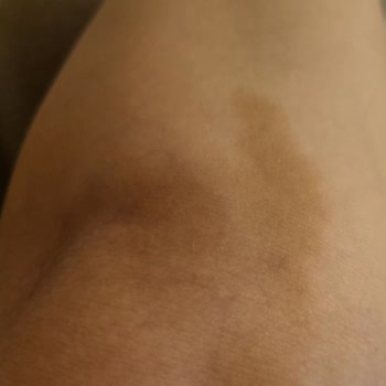 Serum Uygulamasında Yapılan Hata Sonrası Kalıcı Leke Sorunu