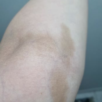 Serum Uygulamasında Yapılan Hata Sonrası Kalıcı Leke Sorunu