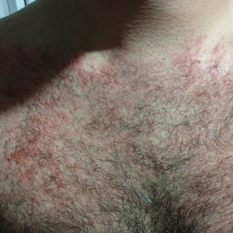 Tüy Dökücü Krem Cildimde İkinci Derece Yanık Ve Tahrişe Sebep Oldu