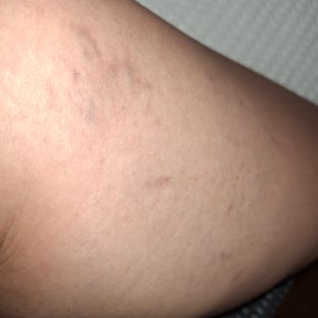 Kızılay Sağlık Grubu Varis Tedavisi Sonrası Bacaklarım Daha Kötü Hale Geldi