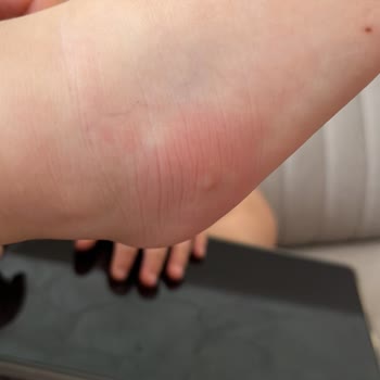 Sinek Kovucu Sprey Etkisiz Kaldı Endişeliyim