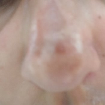 Güneş Kremine Rağmen Yüzümde Güneş Yanığı Oluştu