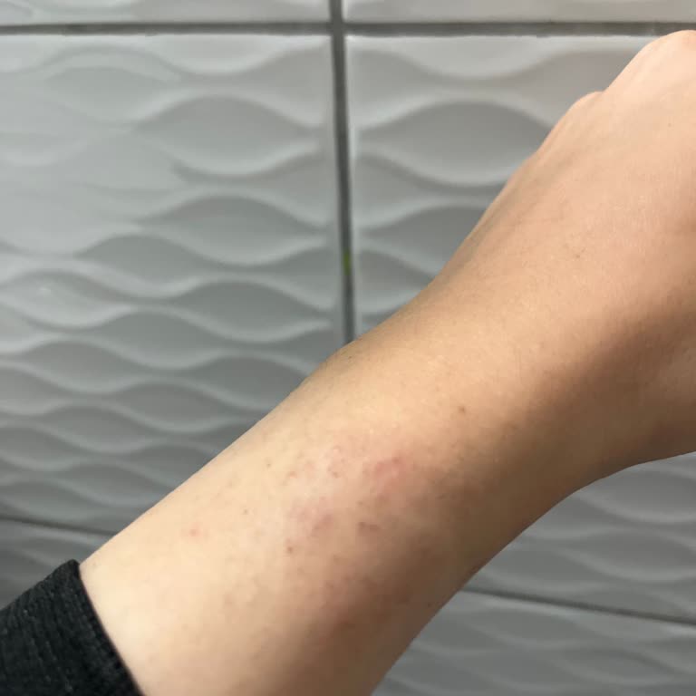 Welder Watch Alerjiye Sebep Oldu