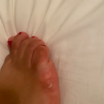 Marjin Terlik Yarası Ve İlgisizlik Şikayeti