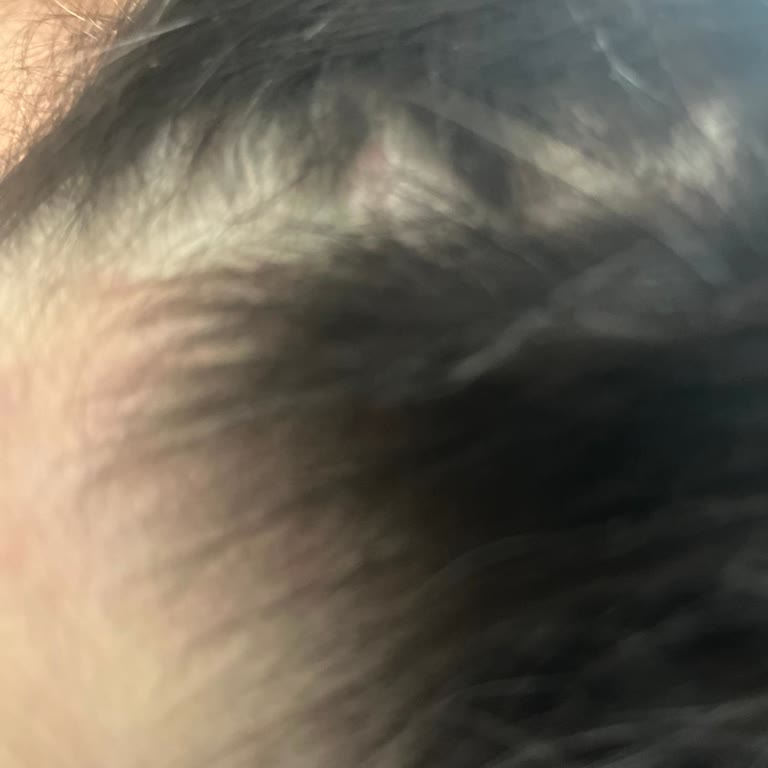 Head&Shoulders Şampuanında Artan Kaşıntı Ve Kepek Sorunu